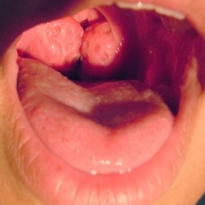 Kissing_Tonsils_354x354