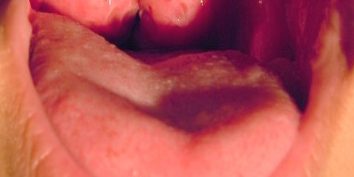 Kissing_Tonsils_354x354